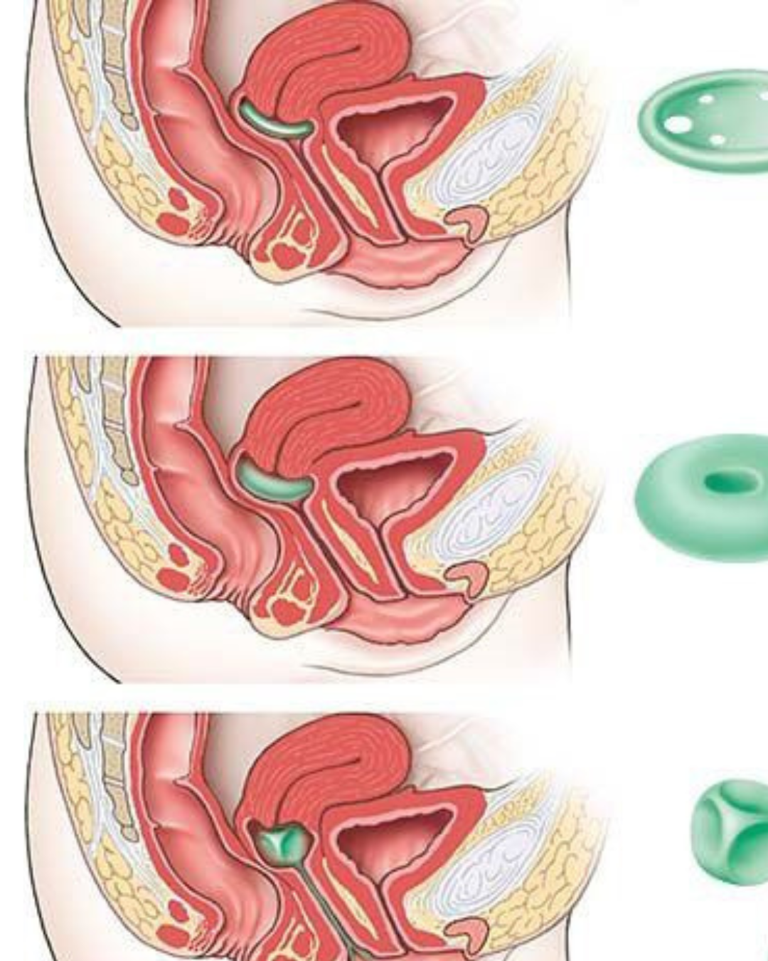 Çanaq orqanlarının sallanması